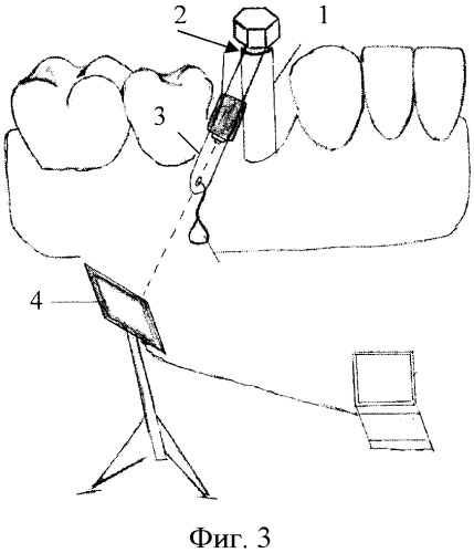 Способ регистрации жесткости закрепления дентальных имплантатов (патент 2373897)