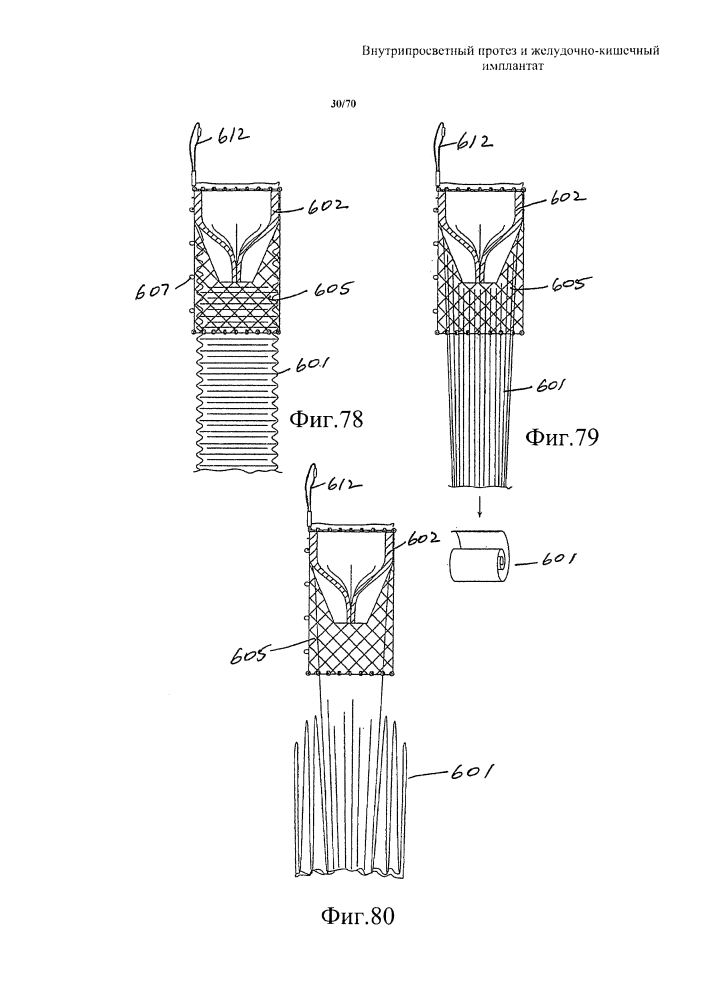 Внутрипросветный протез и желудочно-кишечный имплантат (патент 2626885)