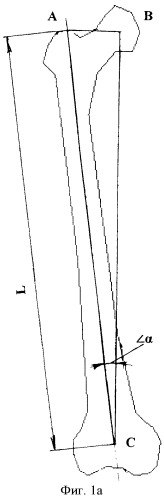 Способ удлинения бедренной кости с одновременным восстановлением биомеханической оси конечности (патент 2441617)