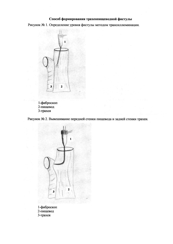 Способ формирования трахеопищеводной фистулы (патент 2634014)