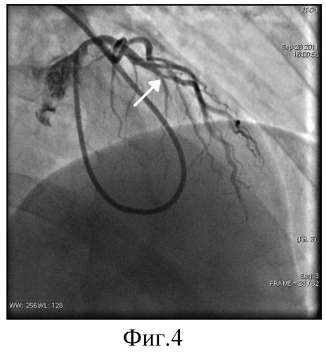 Способ катетеризации коронарных артерий и катетер для его реализации (патент 2556778)