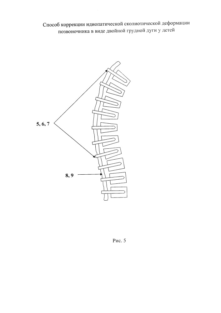 Способ коррекции идиопатической сколиотической деформации позвоночника в виде двойной грудной дуги у детей (патент 2651111)