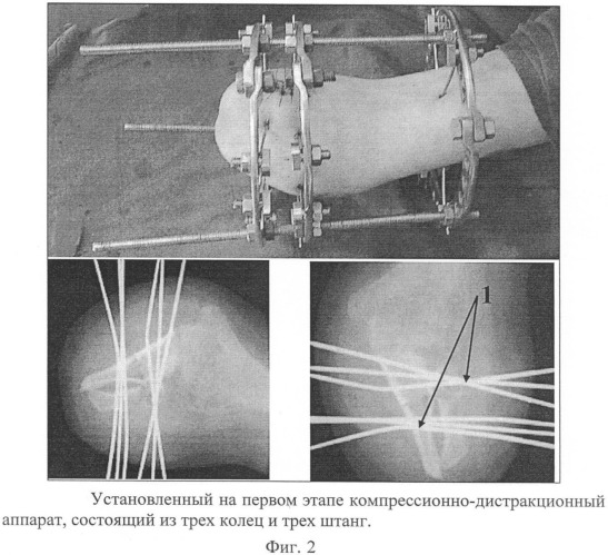 Способ создания функциональности короткой культи предплечья (патент 2392893)