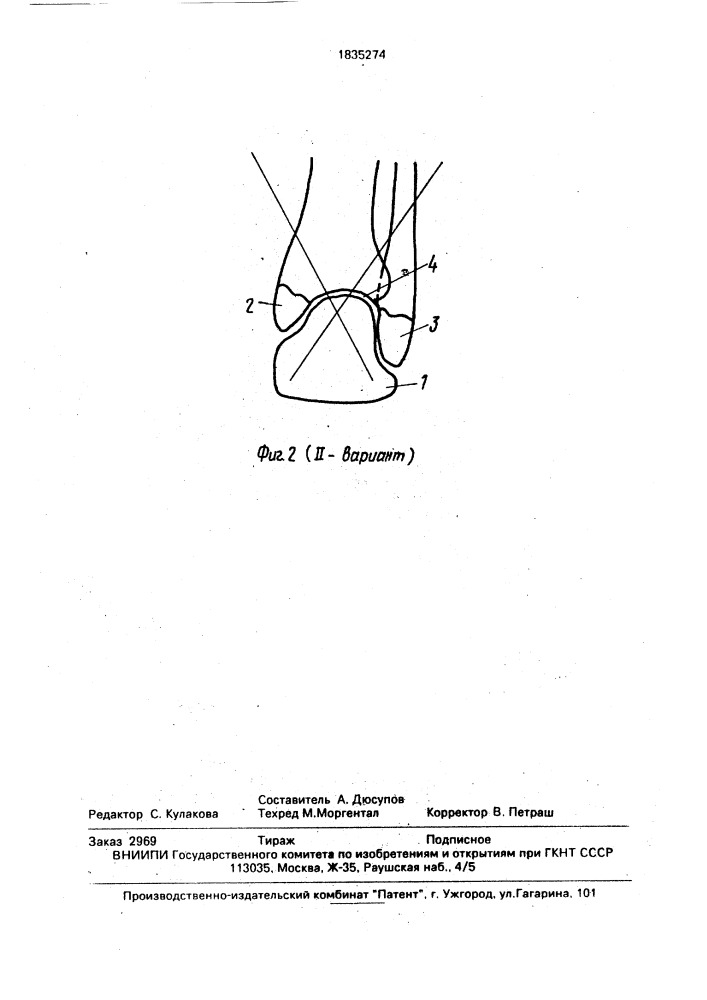 Способ лечения переломов лодыжек с подвывихом стопы (патент 1835274)