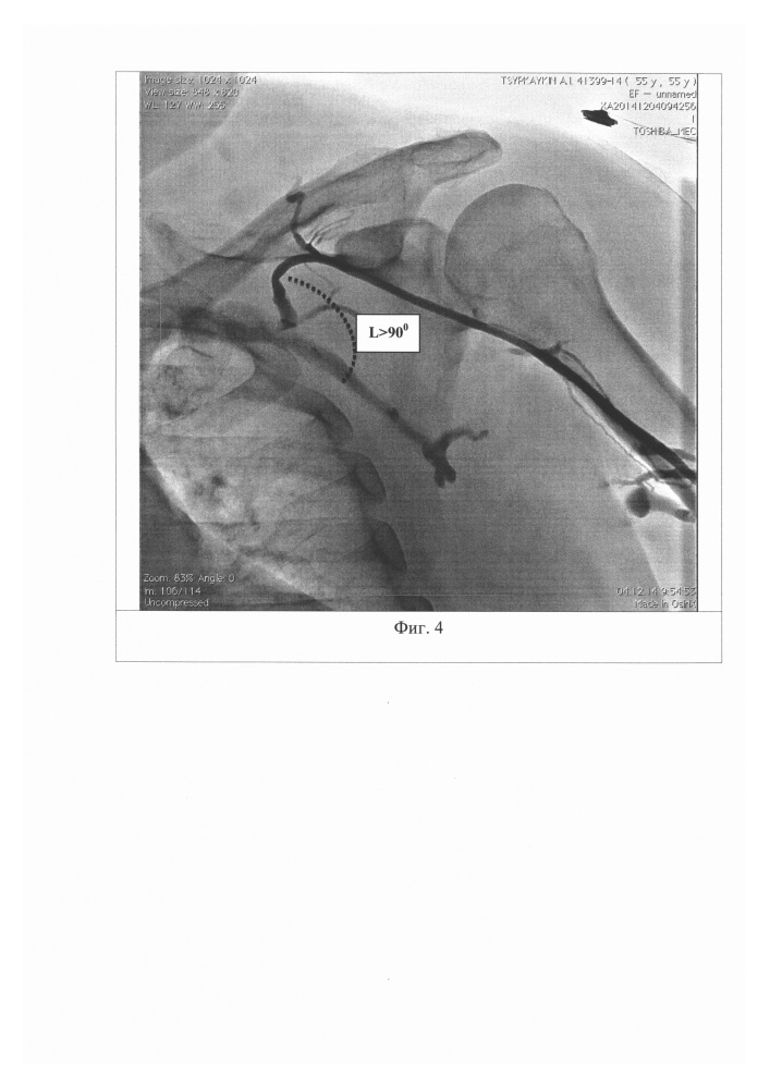 Способ выбора метода проведения эндокардиальных электродов в правые отделы сердца при имплантации антиаритмических устройств (патент 2662417)
