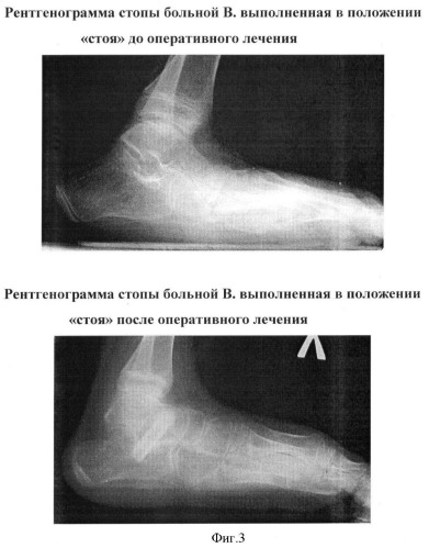 Способ лечения плоско-вальгусной деформации стопы у детей (патент 2372041)