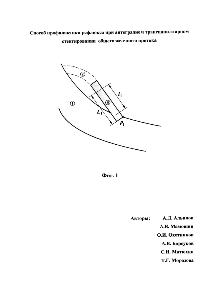 Способ профилактики рефлюкса при антеградном транспапиллярном стентировании общего желчного протока (патент 2652738)