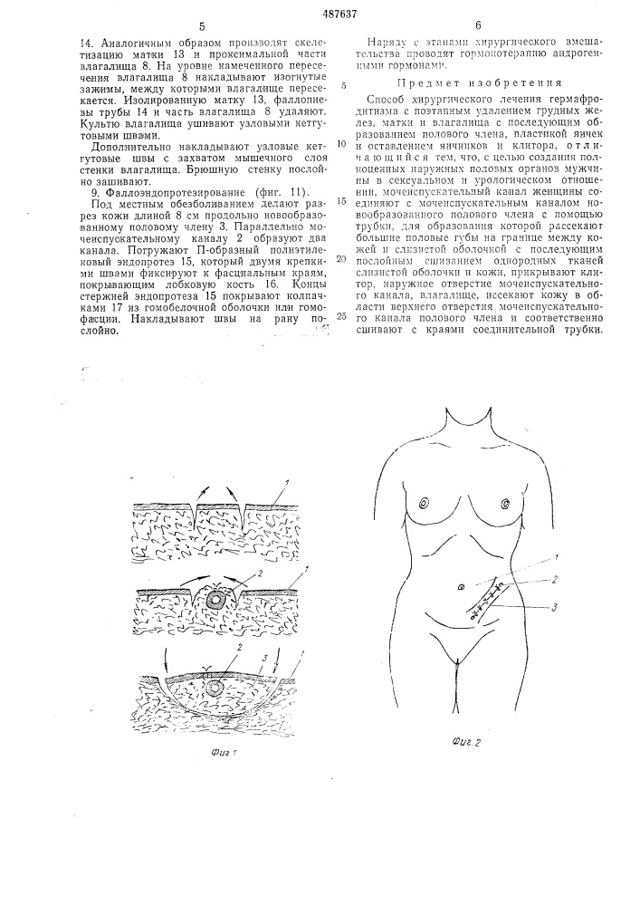 Способ хирургического лечения гермафродитизма (патент 487637)