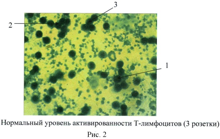 Способ выявления повышенной активированности т-лимфоцитов (патент 2502998)