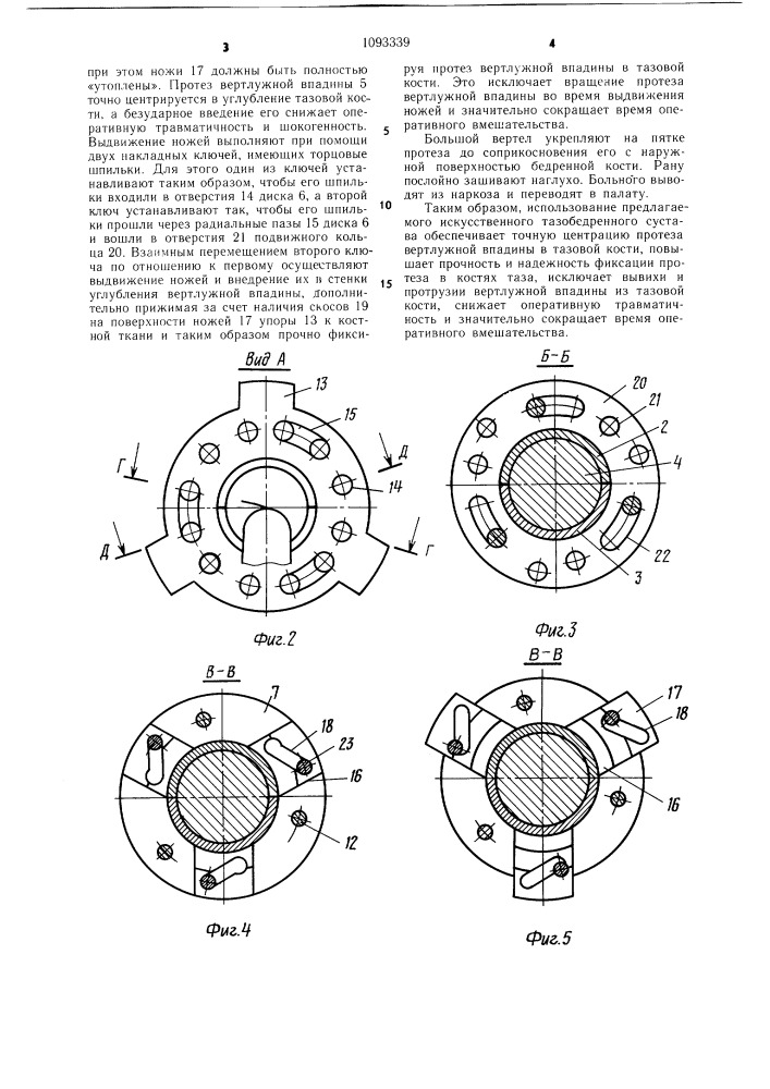 Искусственный тазобедренный сустав (патент 1093339)