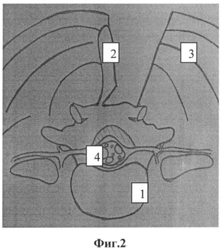 Способ доступа к позвоночному каналу при стенозирующем поражении пояснично-крестцового отдела позвоночника (патент 2508909)