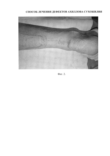 Способ лечения дефектов ахиллова сухожилия (патент 2588491)