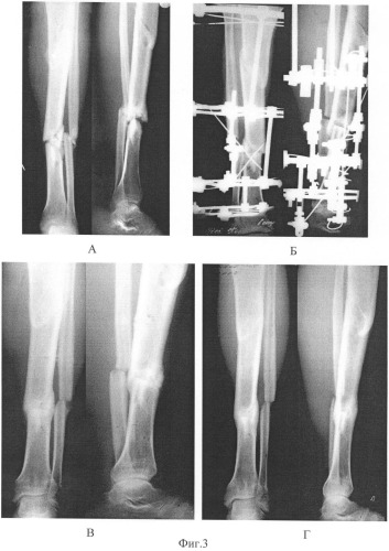 Способ коррекции остеопороза при лечении несросшихся переломов и ложных суставов (патент 2423983)