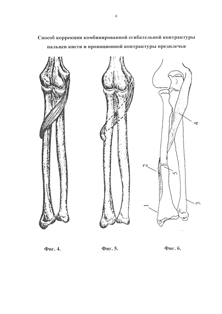 Способ коррекции комбинированной сгибательной контрактуры трехфаланговых пальцев кисти и пронационной контрактуры предплечья (патент 2627290)