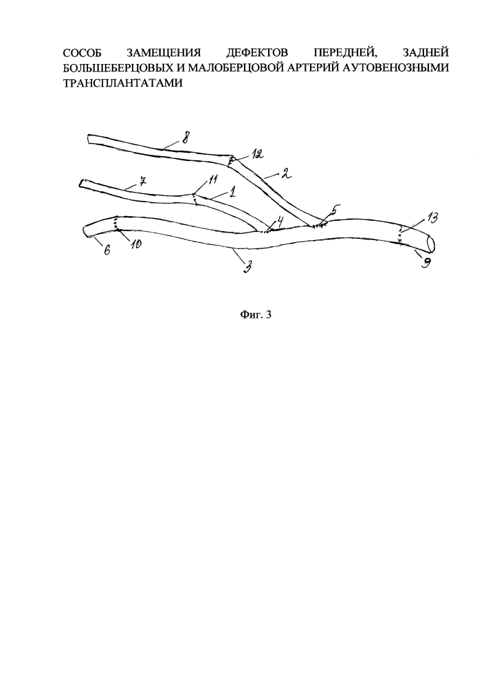 Способ замещения дефектов передней, задней большеберцовых и малоберцовой артерий аутовенозными трансплантатами (патент 2644289)