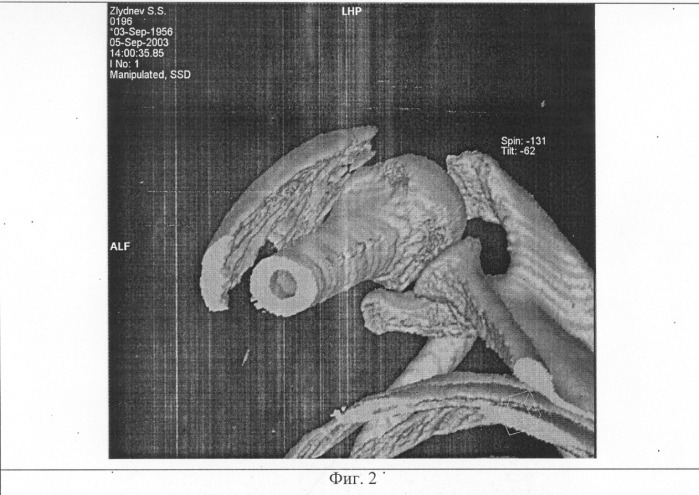 Способ визуализации мышц при компьютерной томографии (патент 2284150)