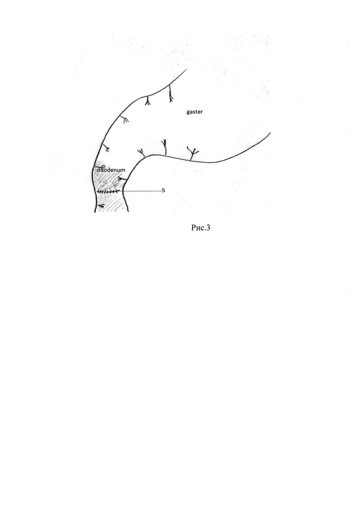 Способ хирургического лечения осложненной язвы двенадцатиперстной кишки (патент 2618649)