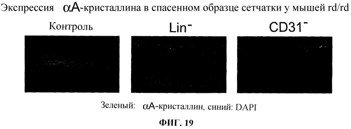 Способ лечения ретинопатии при недоношенности и родственных ретинопатических заболеваний (патент 2403906)