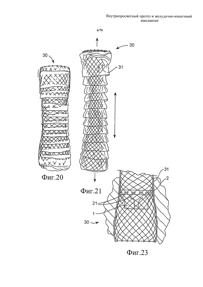 Внутрипросветный протез и желудочно-кишечный имплантат (патент 2626885)