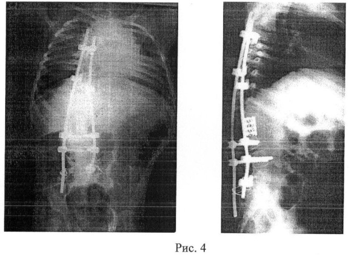 Способ дополнительной фиксации металлоконструкции к костям таза при коррекции врожденного кифосколиоза позвоночника на фоне нарушения формирования позвонков грудопоясничной и поясничной локализации у детей (патент 2444317)