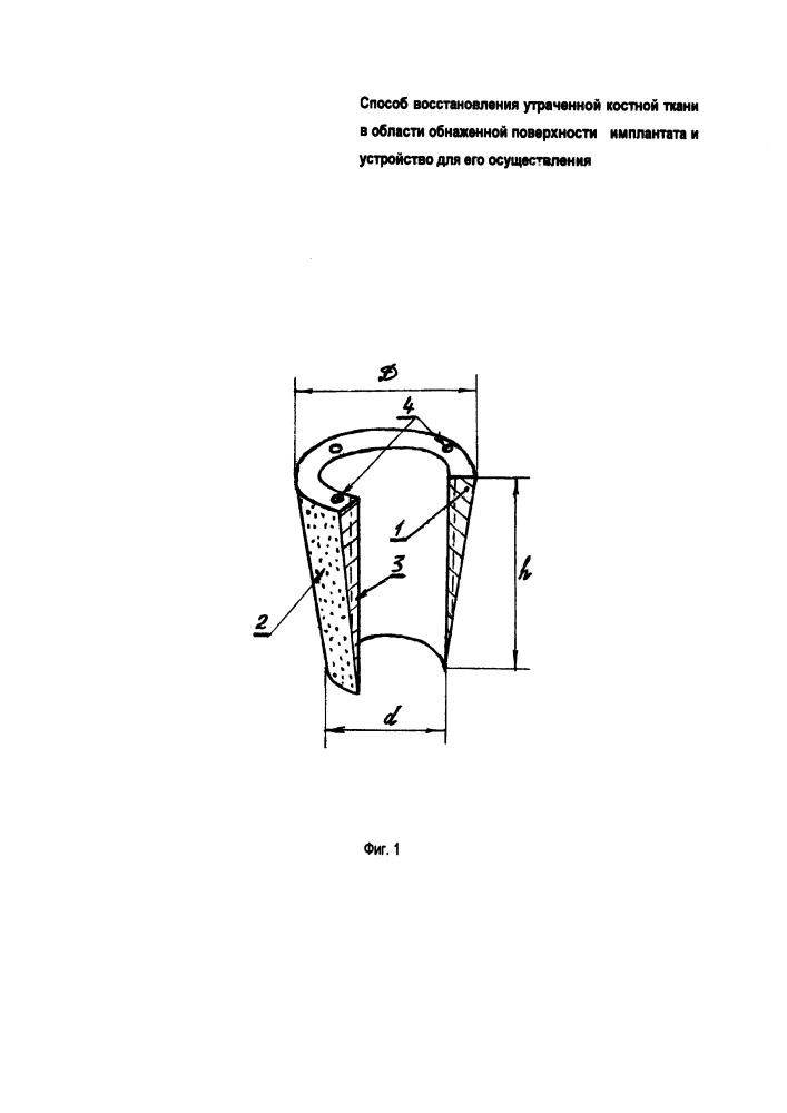 Устройство для восстановления утраченной костной ткани вокруг обнаженной поверхности имплантата и способ его использования (патент 2604049)