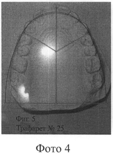 Способ контроля ортодонтической коррекции верхней зубной дуги и ее сегментов (патент 2486875)