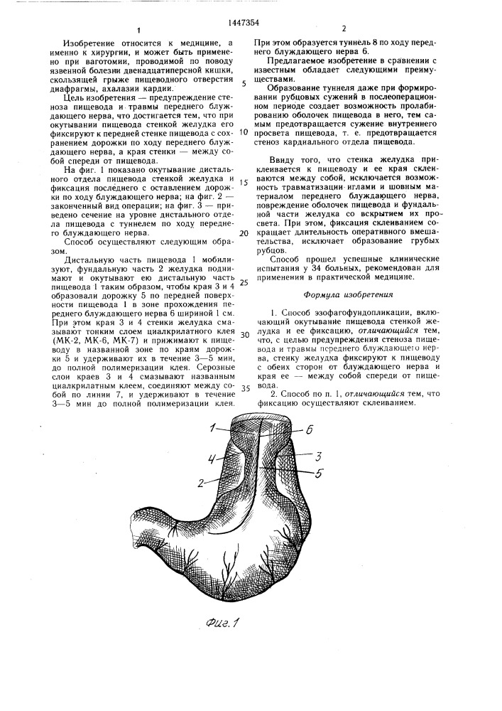 Способ эзофагофундопликации (патент 1447354)