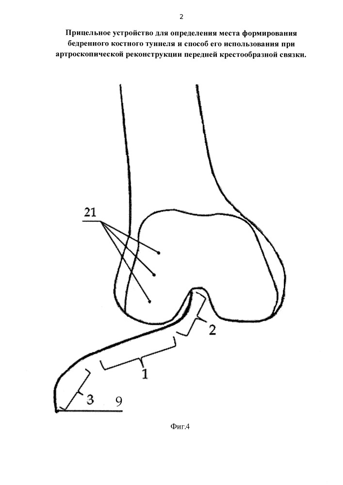 Прицельное устройство для определения места формирования бедренного костного туннеля и способ его использования при артроскопической реконструкции передней крестообразной связки (патент 2655079)