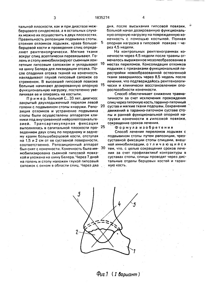 Способ лечения переломов лодыжек с подвывихом стопы (патент 1835274)