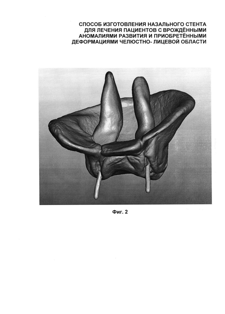Способ изготовления назального стента для лечения пациентов с врождёнными аномалиями развития и приобретёнными деформациями челюстно-лицевой области (патент 2618187)