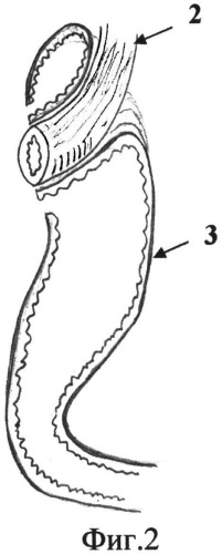 Способ формирования конце-бокового пищеводно-желудочного анастомоза после проксимальной резекции желудка (патент 2535075)