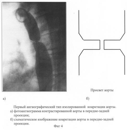 Способ диагностики изолированной коарктации аорты и способ выбора тактики ее лечения (патент 2244510)