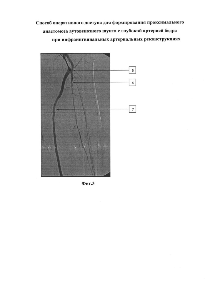 Способ оперативного доступа для формирования проксимального анастомоза аутовенозного шунта с глубокой артерией бедра при инфраингвинальных артериальных реконструкциях (патент 2617205)