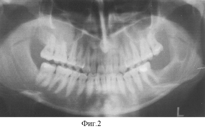 Способ восстановления костной ткани челюстей после операции цистэктомии (патент 2311181)