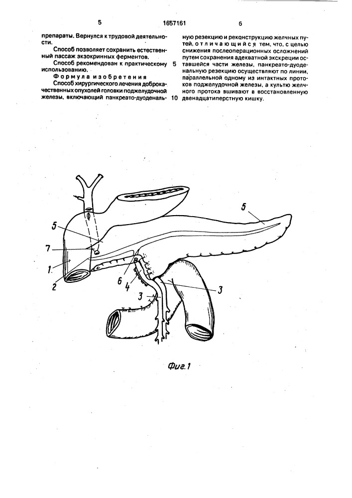 Способ хирургического лечения доброкачественных опухолей головки поджелудочной железы (патент 1657161)