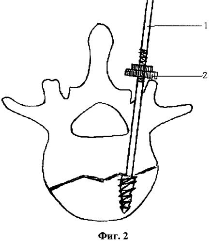 Способ репозиции и фиксации позвоночника при оскольчатых переломах (патент 2436534)