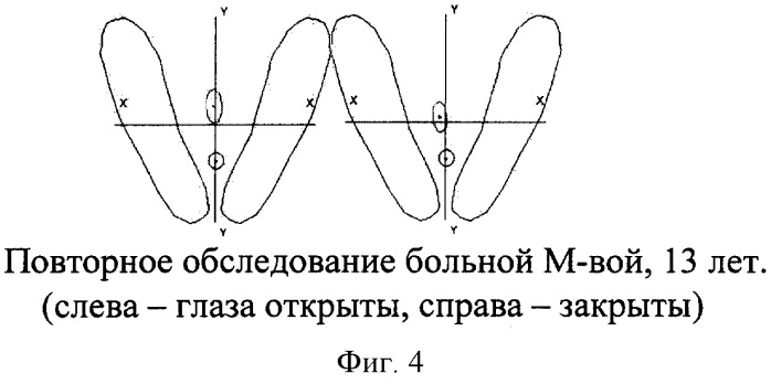 Способ прогнозирования прогрессирования сколиотической деформации (патент 2302818)