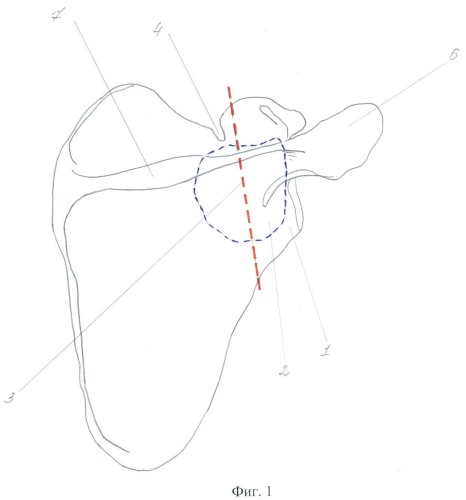 Способ лечения доброкачественных опухолей и опухолеподобных поражений шейки лопатки у детей (патент 2407471)