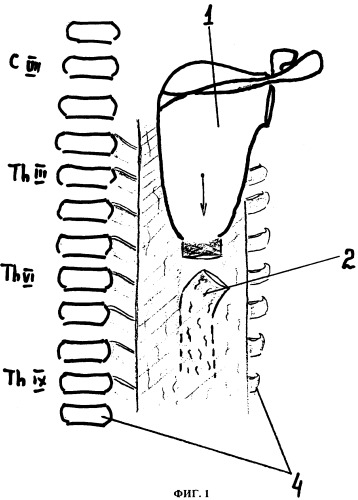 Способ фиксации низведенной лопатки при лечении детей с болезнью шпренгеля (патент 2359629)