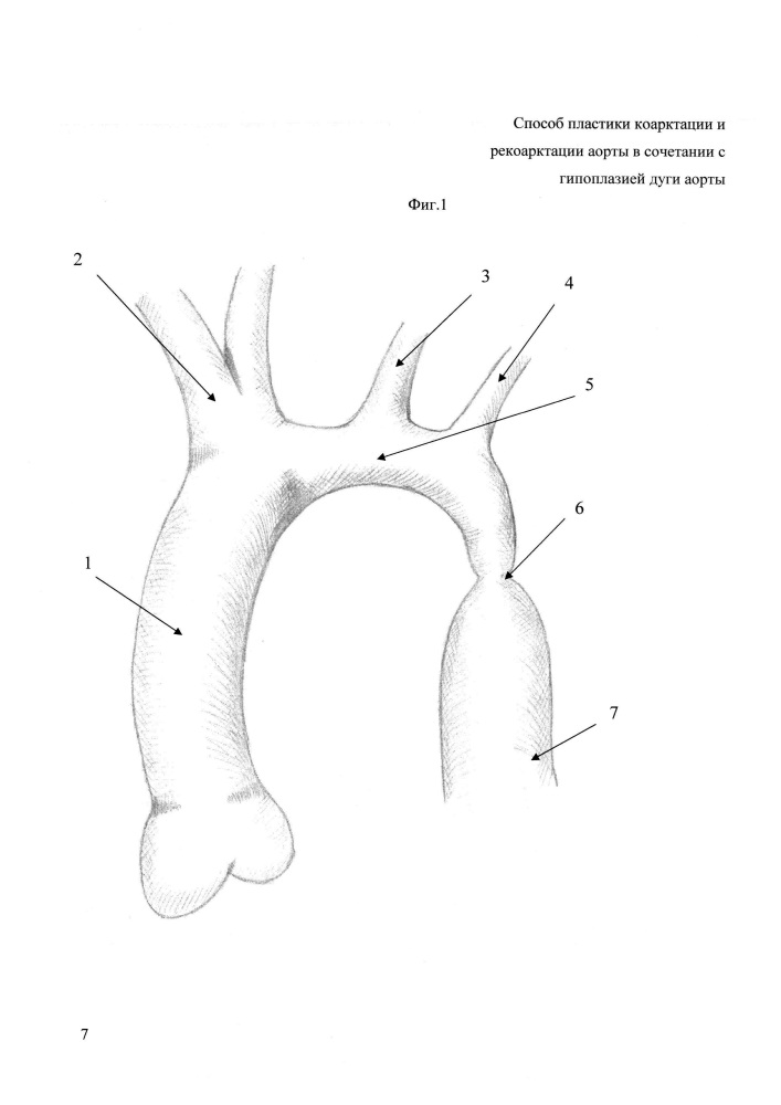 Способ пластики коарктации и рекоарктации аорты в сочетании с гипоплазией дуги аорты (патент 2621953)