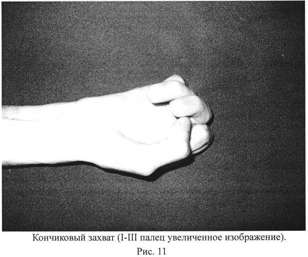 Кодон-оптимизированная рекомбинантная плазмида, способ стимуляции регенерации периферического нерва, способ лечения поврежденного нерва человека (патент 2558294)