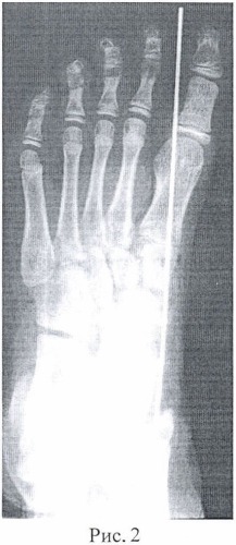 Способ лечения вальгусно-приведенной деформации стопы (патент 2481078)