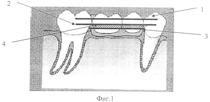 Мостовидный протез для восстановления отсутствующих второго премоляра и/или первого моляра прямым методом (патент 2333733)