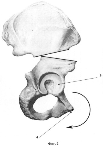 Способ выполнения ротационной транспозиции вертлужной впадины (патент 2402989)