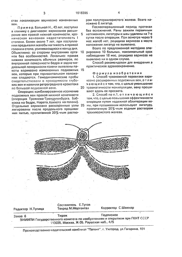 Способ чрезкожной перевязки варикозно расширенных подкожных вен (патент 1618395)