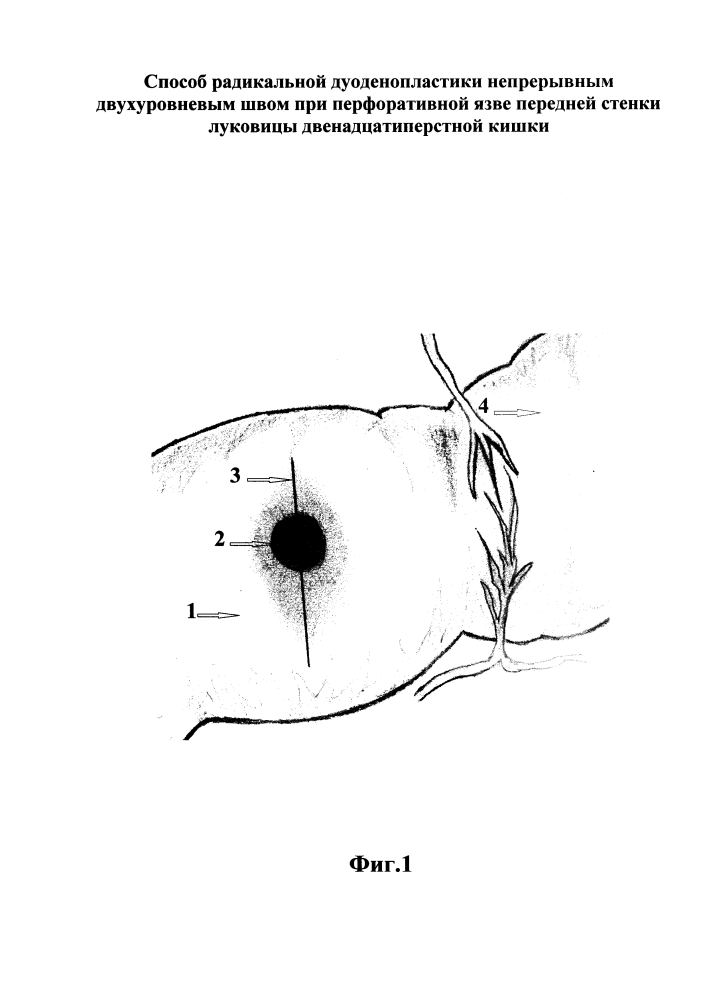 Способ радикальной дуоденопластики непрерывным двухуровневым швом при перфоративной язве передней стенки луковицы двенадцатиперстной кишки (патент 2654272)