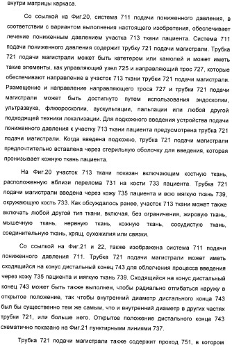 Способ лечения путем подкожной подачи пониженного давления с использованием разделения с помощью воздушного баллона (патент 2405588)