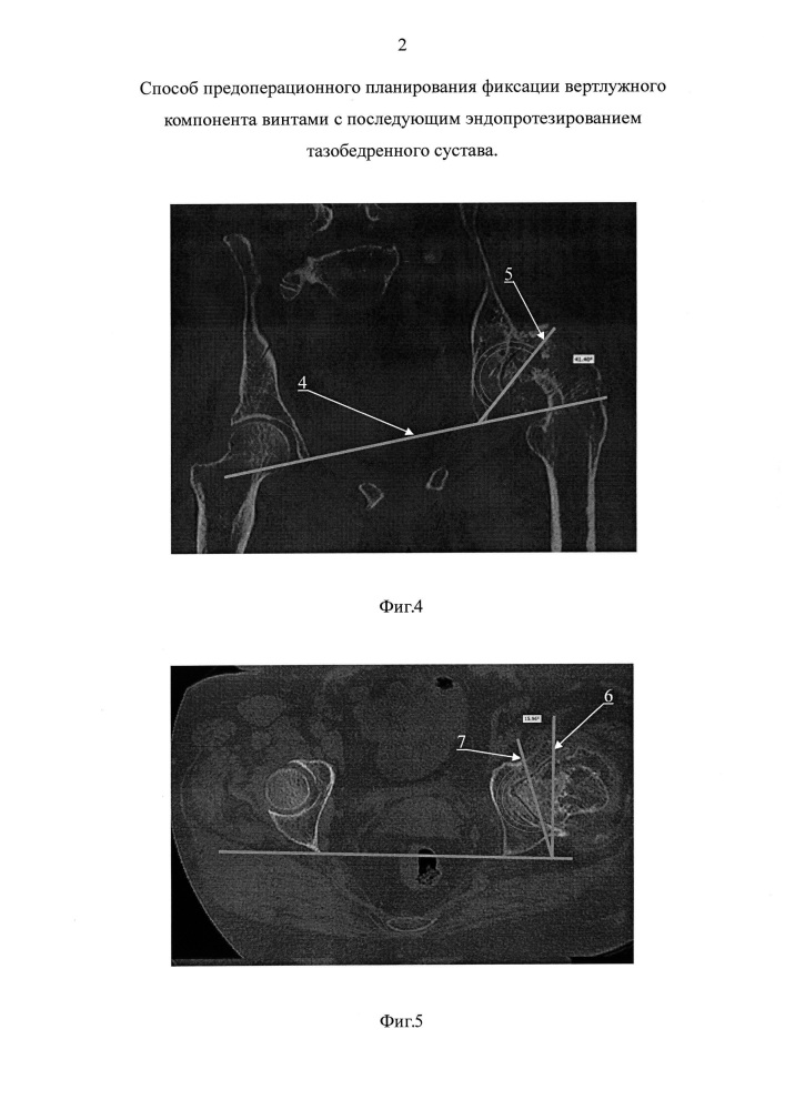 Способ предоперационного планирования фиксации вертлужного компонента винтами с последующим эндопротезированием тазобедренного сустава (патент 2665153)