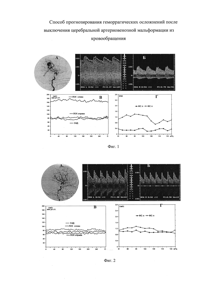 Способ прогнозирования геморрагических осложнений после выключения церебральной артериовенозной мальформации из кровообращения (патент 2598758)
