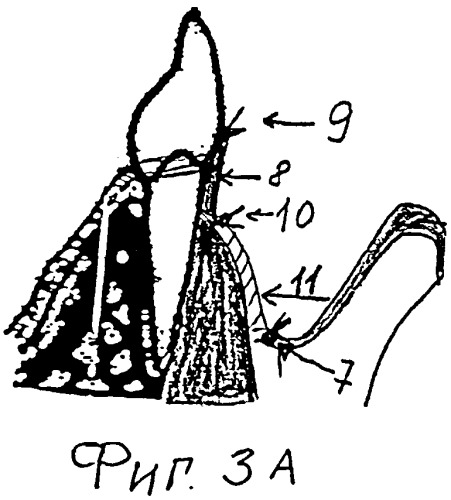 Способ вестибулопластики полости рта (патент 2531446)